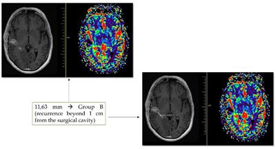 Photodynamic therapy in glioblastoma: Detection of intraoperative inadvertent 5-ALA mediated photodynamic therapeutical effect after gross total resection